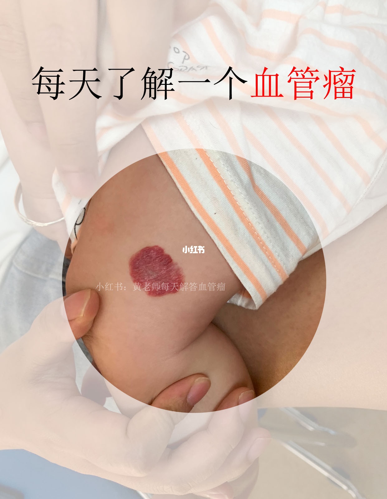血管瘤公司会要吗？全面解读招聘与雇佣问题