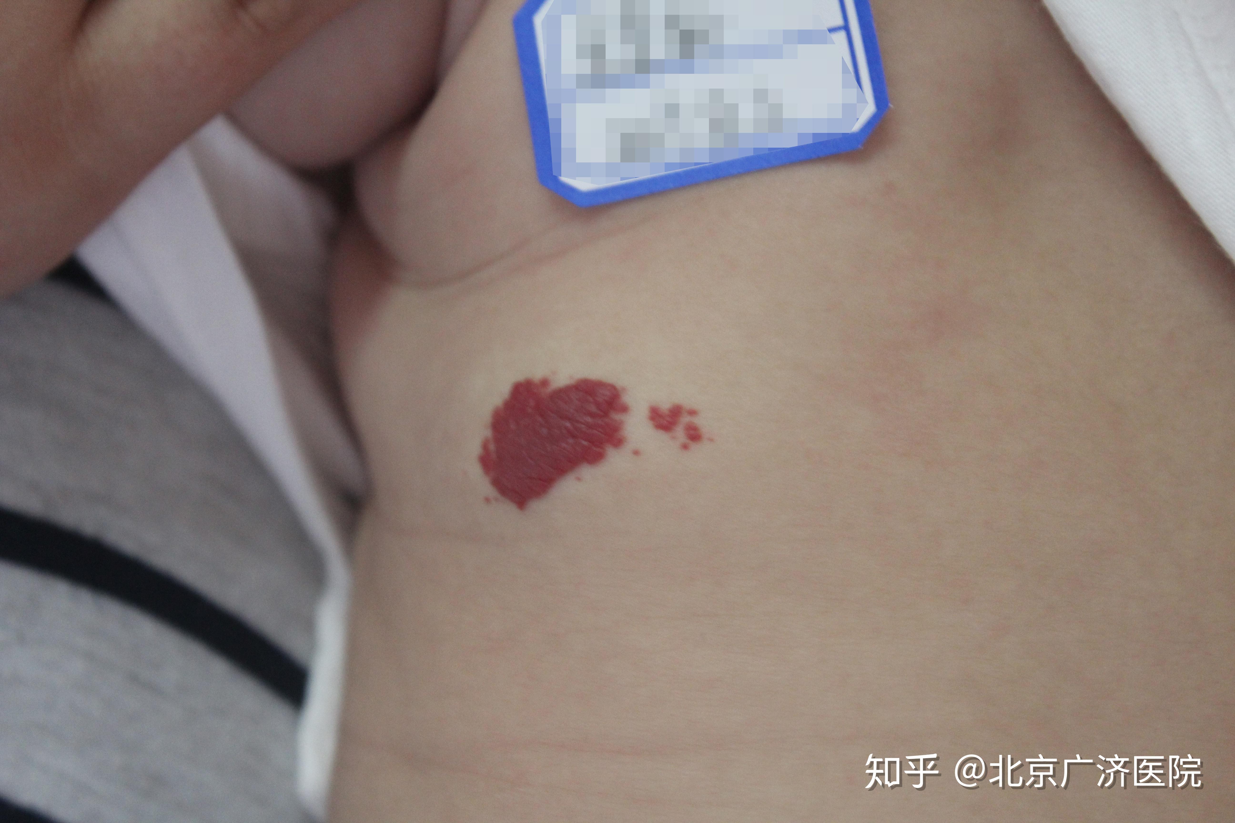 有血管瘤会影响入职吗？百度知道解读
