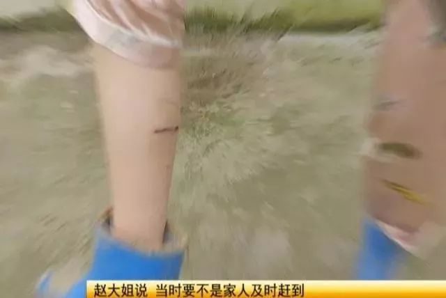 被蛇咬后二十年会复发不，深度解析与科学解读