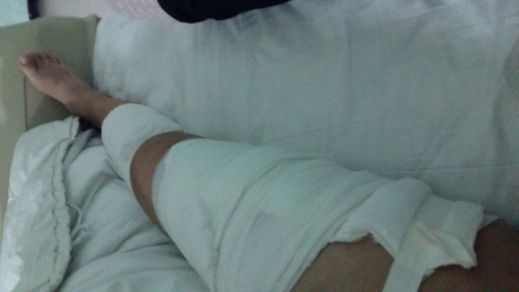 腿断掉了，多少时间内可以重新接上？——骨骼再生与恢复的奥秘