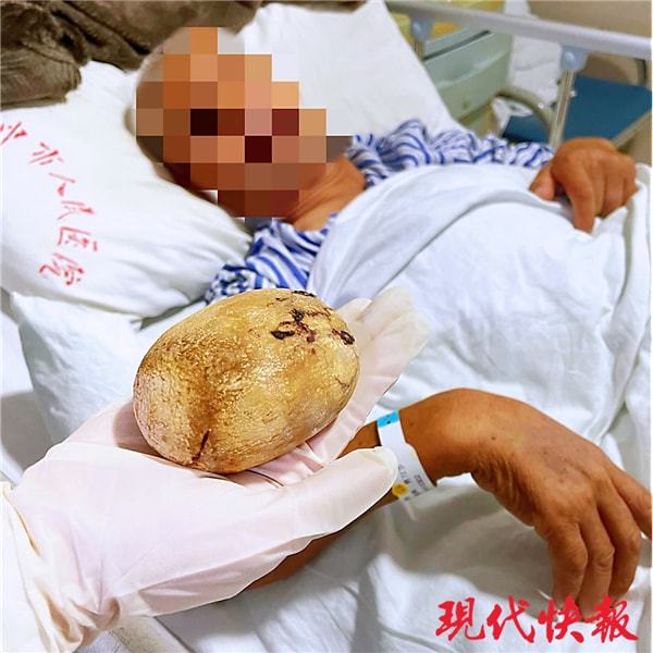七旬老人体内惊现巨大胆结石，医生成功手术取出