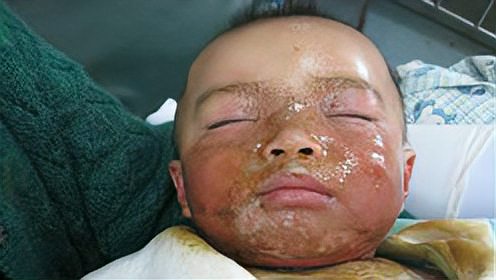 妈妈炸鸡块热油不慎从孩子头上洒下——一个家庭的痛苦与反思