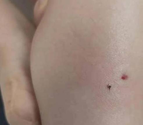 小孩被蜜蜂蛰了会自愈吗？全面解读与处理建议