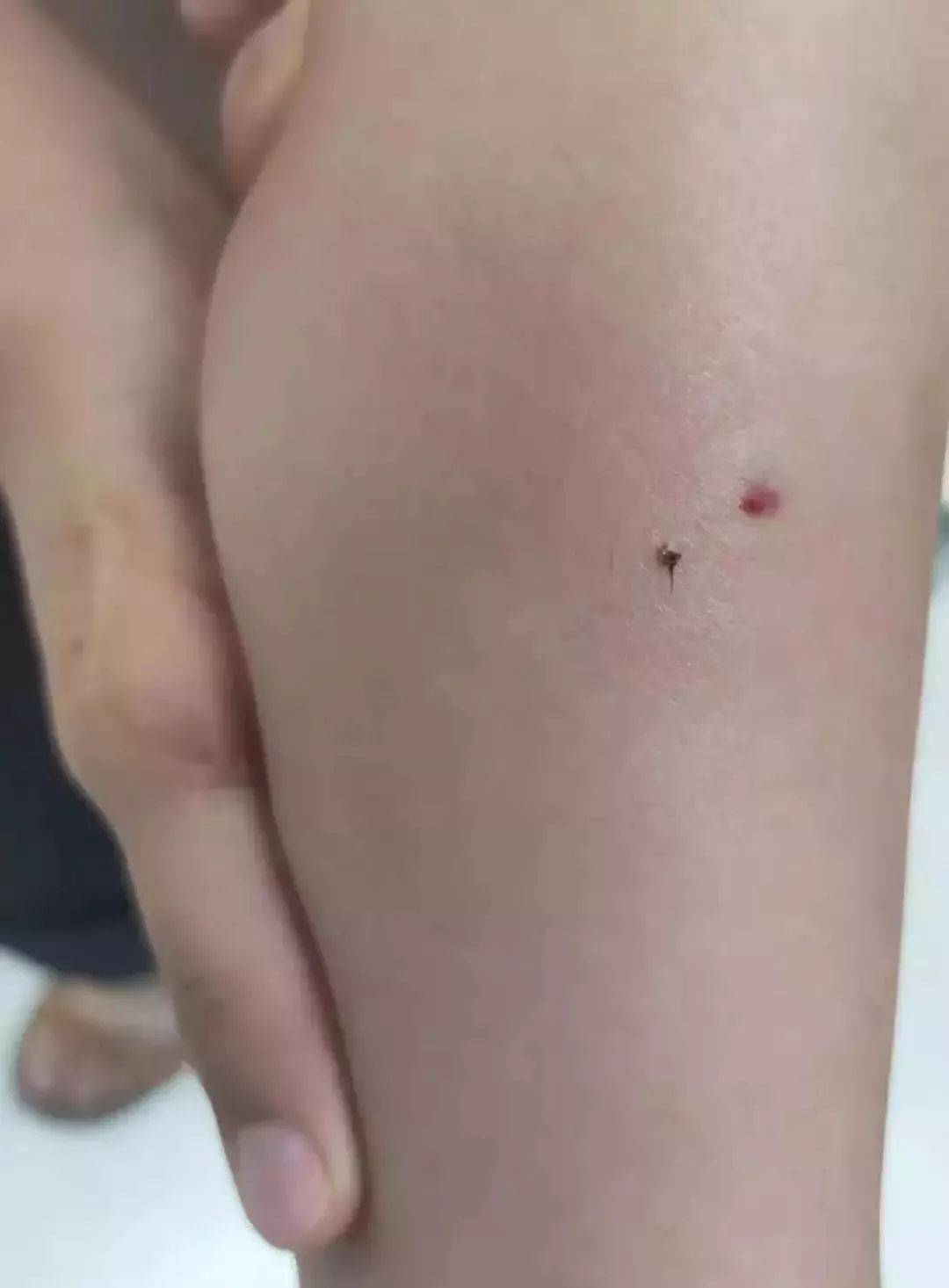 小孩被蜜蜂蛰了会不会有危险