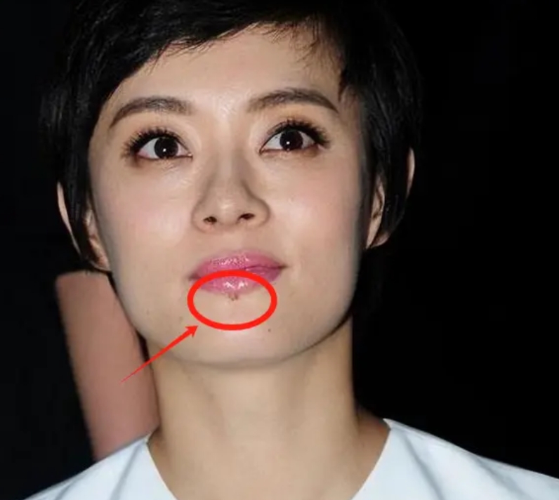 孙俪的唇下痣会有癌变风险吗？解读与解析